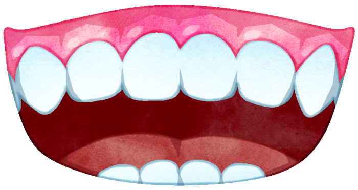 ガミースマイルの口のイラストです。ガミーフェイス、ガミーマウス、ガミーとも呼ばれたりします。笑うと上の歯の歯茎が見える状態をガミースマイルといいます。